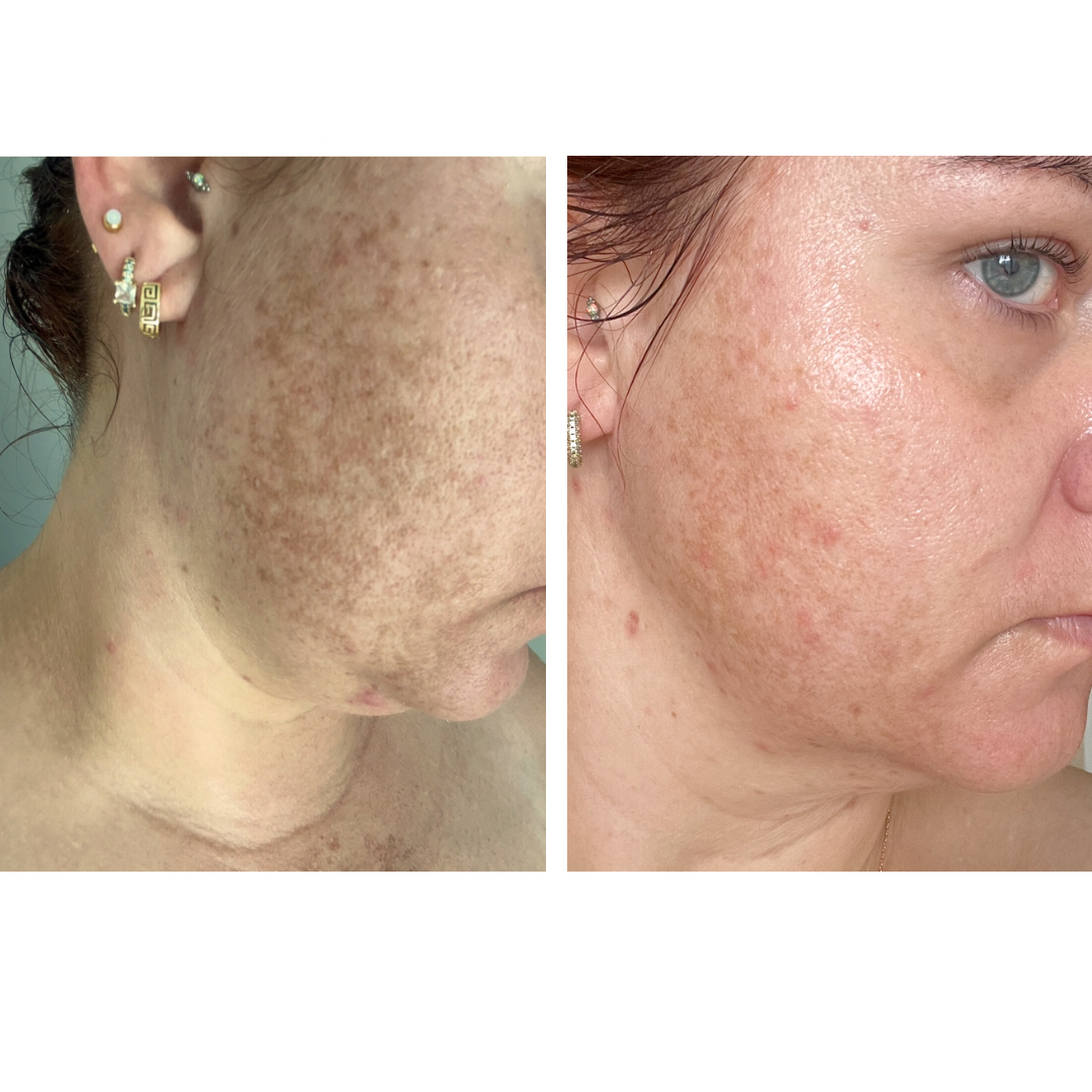 Niacinamide 10% + TXA 4% Dark Spot Correcting Serum 30ml