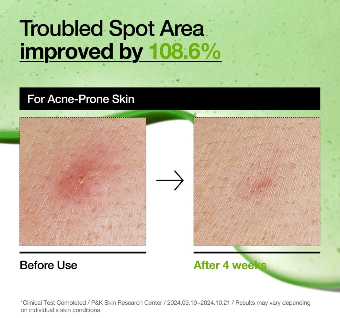 Azelaic Acid 10 Hyaluron Redness Soothing Serum 30ml
